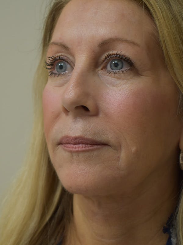 Facelift Before & After Gallery - Patient 512585 - Image 8
