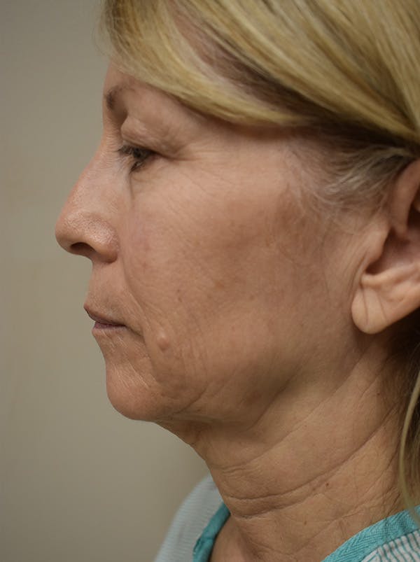 Facelift Before & After Gallery - Patient 512585 - Image 9