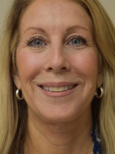 Facelift Before & After Gallery - Patient 512585 - Image 2