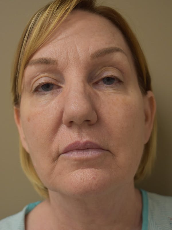 Facelift Before & After Gallery - Patient 175873 - Image 1