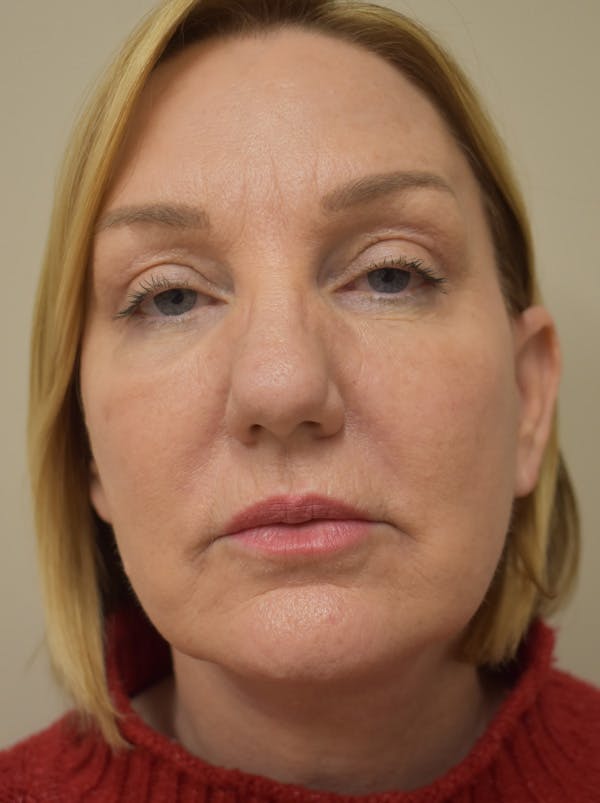Facelift Before & After Gallery - Patient 175873 - Image 2