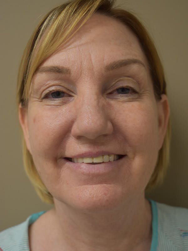 Facelift Before & After Gallery - Patient 175873 - Image 3