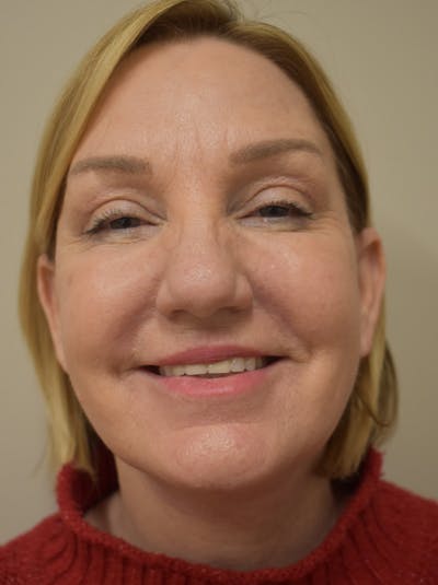 Facelift Before & After Gallery - Patient 175873 - Image 4