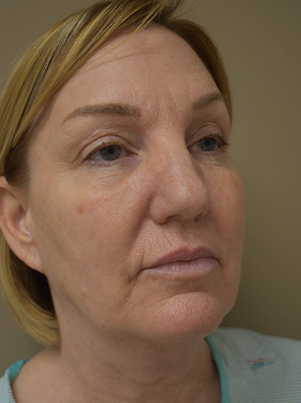 Facelift Before & After Gallery - Patient 175873 - Image 5