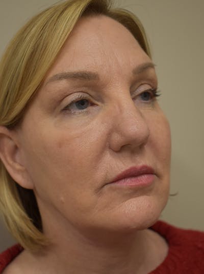 Facelift Before & After Gallery - Patient 175873 - Image 6