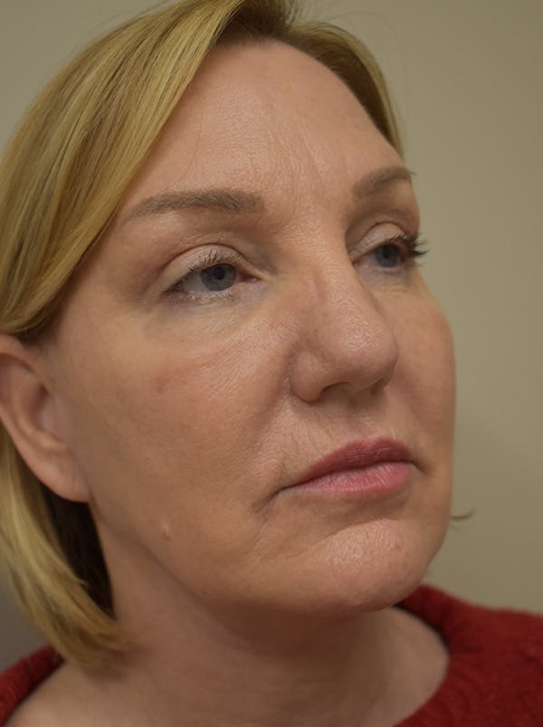 Facelift Before & After Gallery - Patient 175873 - Image 6