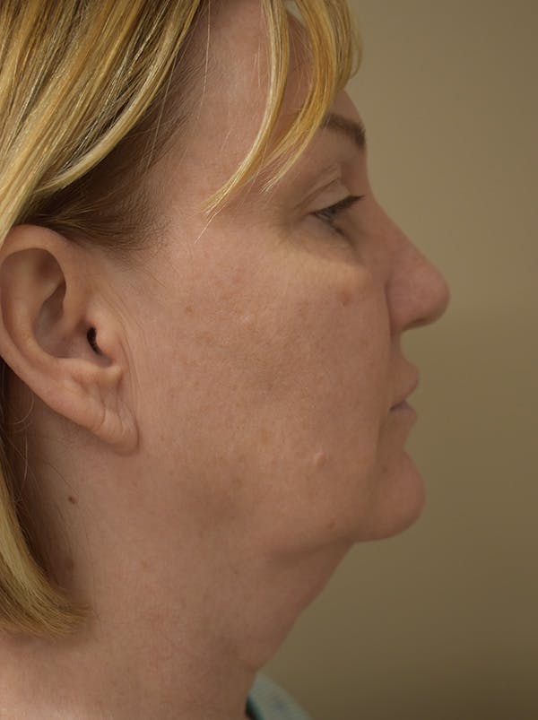 Facelift Before & After Gallery - Patient 175873 - Image 7