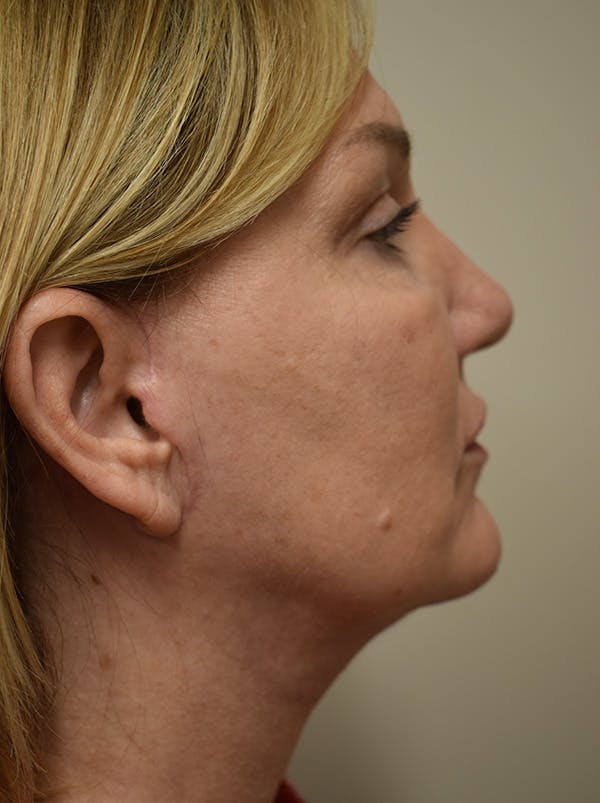 Facelift Before & After Gallery - Patient 175873 - Image 8