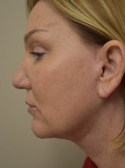 Facelift Before & After Gallery - Patient 175873 - Image 12