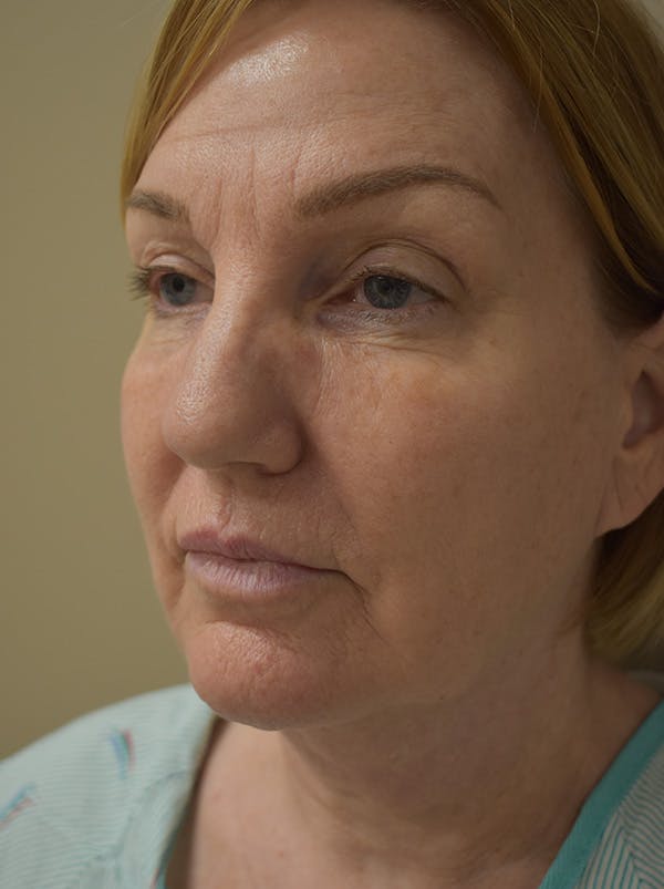 Facelift Before & After Gallery - Patient 175873 - Image 9