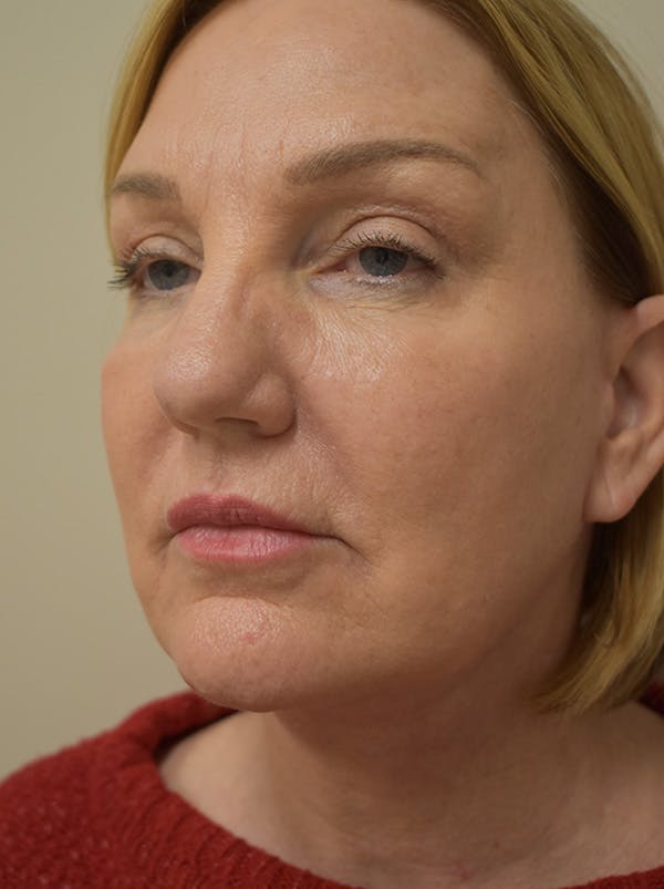 Facelift Before & After Gallery - Patient 175873 - Image 10