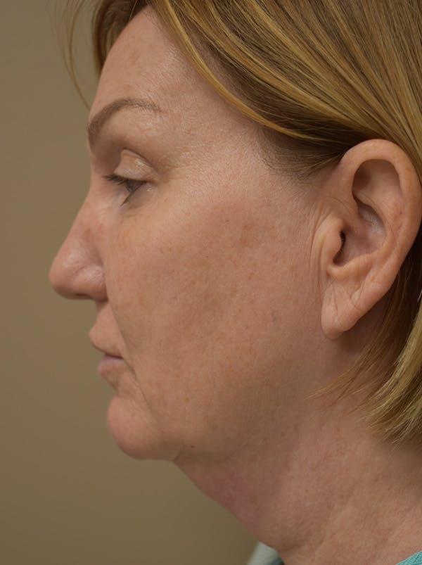 Facelift Before & After Gallery - Patient 175873 - Image 11