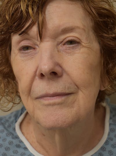 Facelift Before & After Gallery - Patient 186870 - Image 1