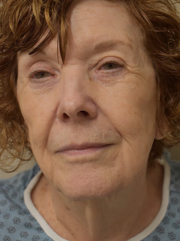 Facelift Before & After Gallery - Patient 186870 - Image 1