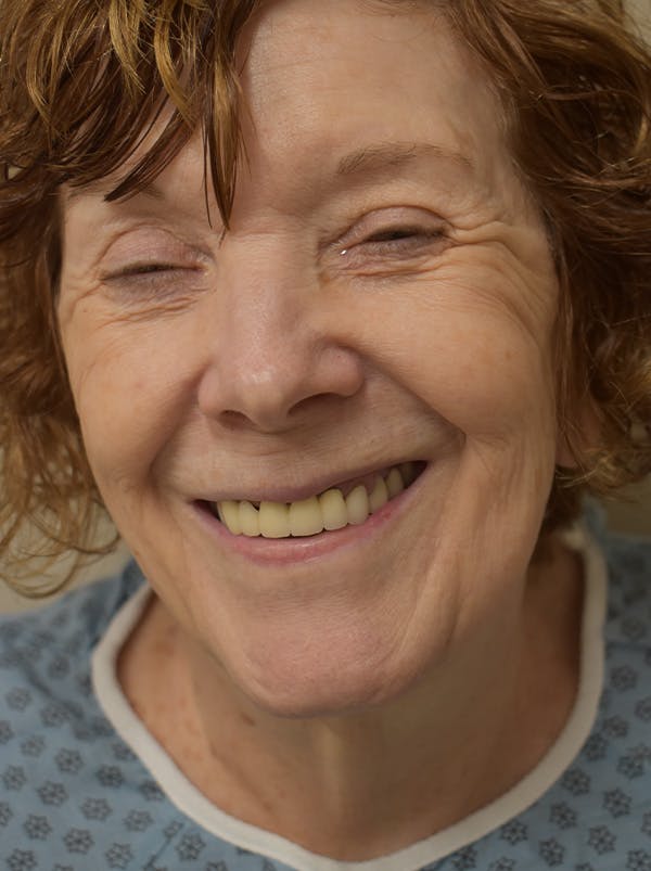 Facelift Before & After Gallery - Patient 186870 - Image 3