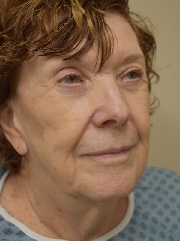 Facelift Before & After Gallery - Patient 186870 - Image 5