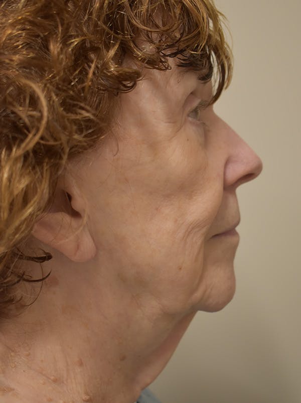 Facelift Before & After Gallery - Patient 186870 - Image 7