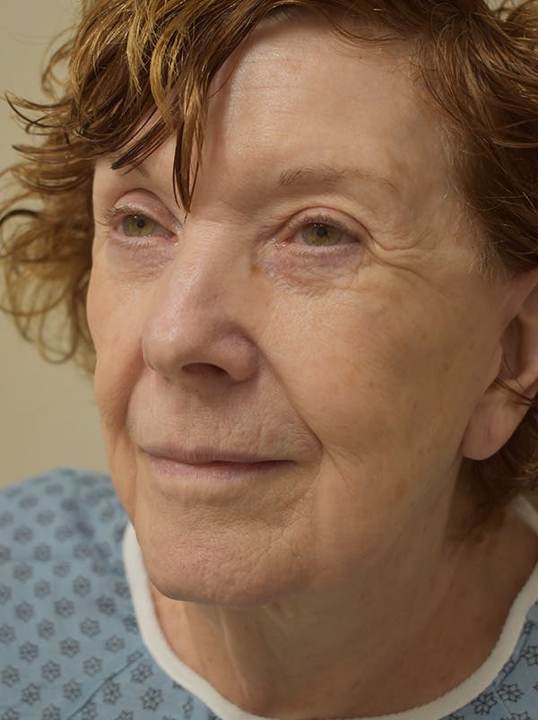 Facelift Before & After Gallery - Patient 186870 - Image 9