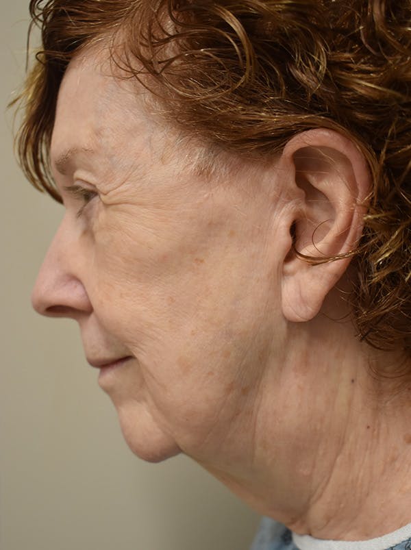 Facelift Before & After Gallery - Patient 186870 - Image 11