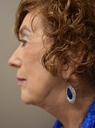 Facelift Before & After Gallery - Patient 186870 - Image 12