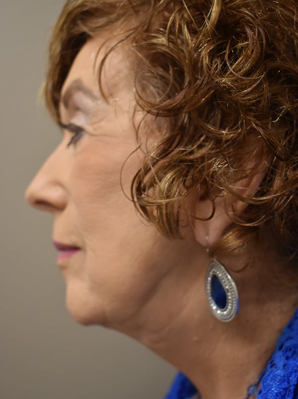 Facelift Before & After Gallery - Patient 186870 - Image 12