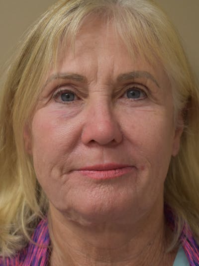 Facelift Before & After Gallery - Patient 191495 - Image 1