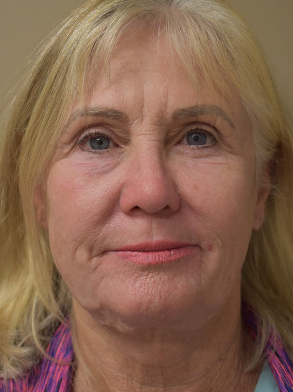 Facelift Before & After Gallery - Patient 191495 - Image 1