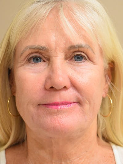 Facelift Before & After Gallery - Patient 191495 - Image 2