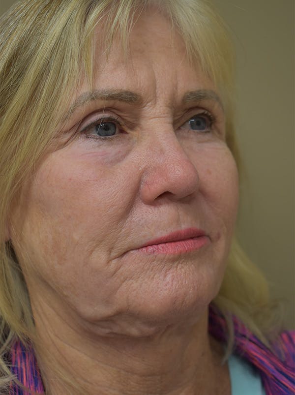 Facelift Before & After Gallery - Patient 191495 - Image 3