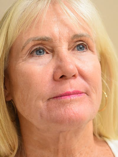 Facelift Before & After Gallery - Patient 191495 - Image 4