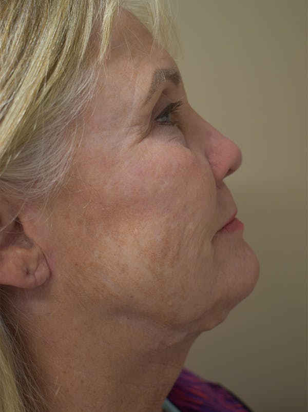 Facelift Before & After Gallery - Patient 191495 - Image 5
