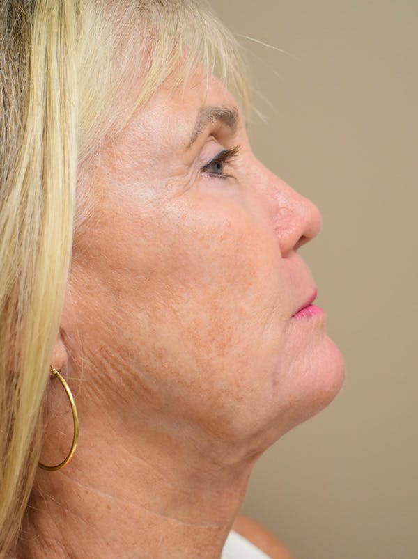 Facelift Before & After Gallery - Patient 191495 - Image 6