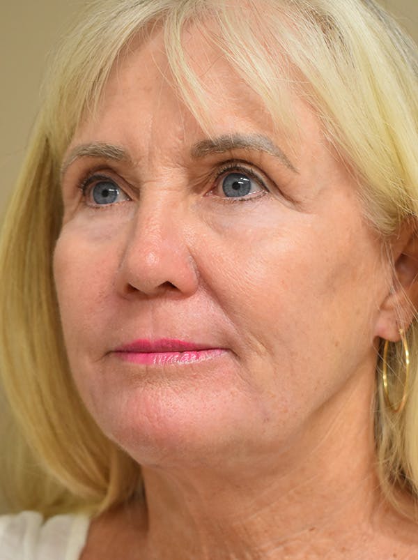 Facelift Before & After Gallery - Patient 191495 - Image 8