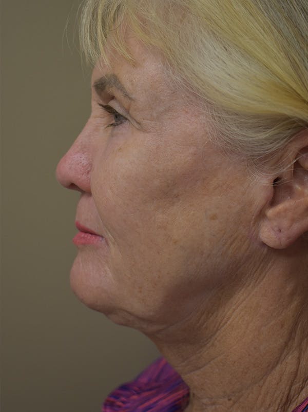 Facelift Before & After Gallery - Patient 191495 - Image 9