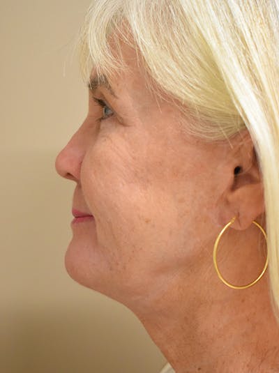 Facelift Before & After Gallery - Patient 191495 - Image 10