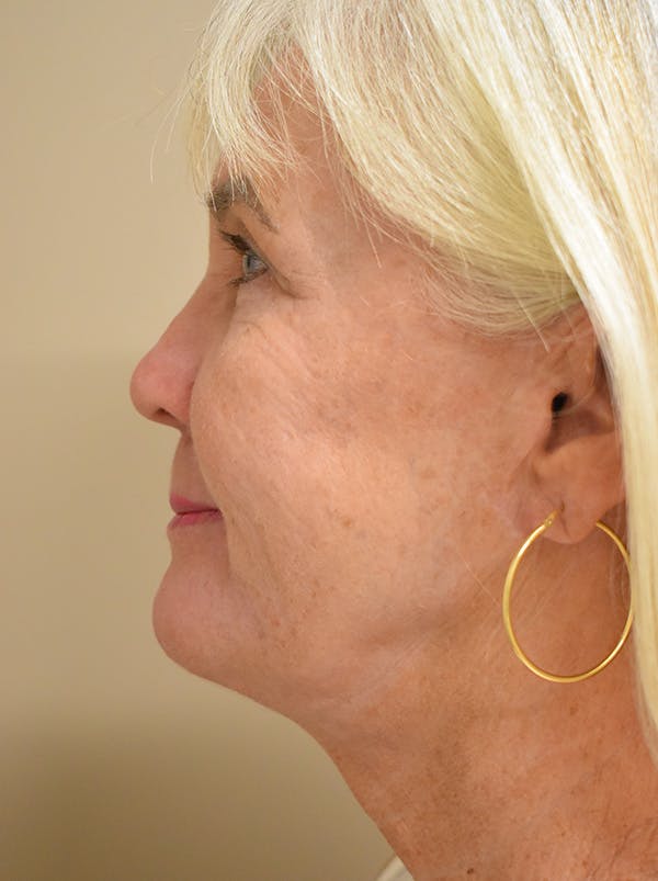 Facelift Before & After Gallery - Patient 191495 - Image 10