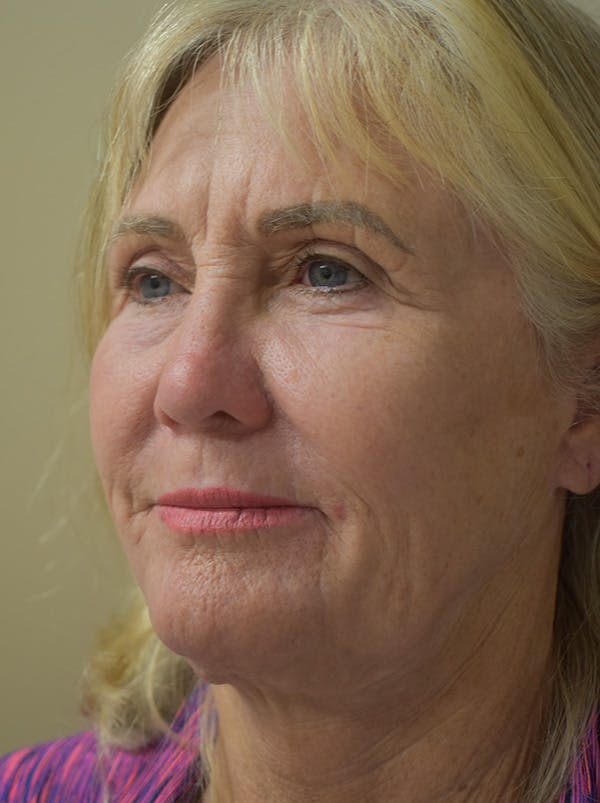 Facelift Before & After Gallery - Patient 191495 - Image 7