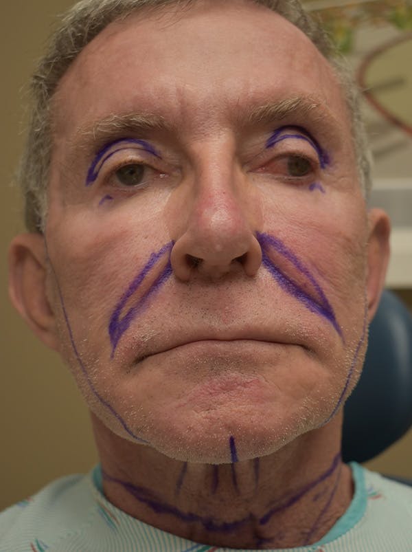 Facelift Before & After Gallery - Patient 166903 - Image 1