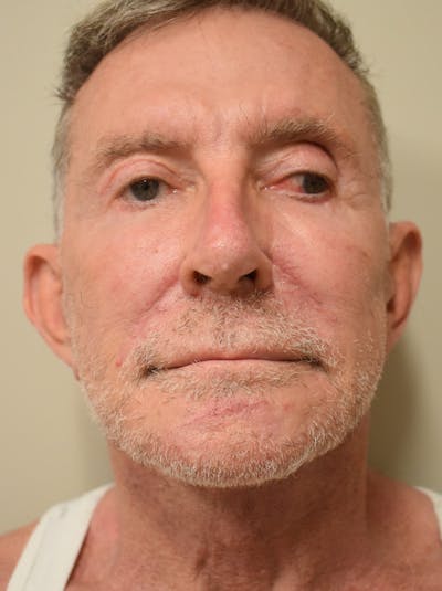 Facelift Before & After Gallery - Patient 166903 - Image 2