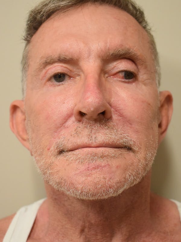 Facelift Before & After Gallery - Patient 166903 - Image 2