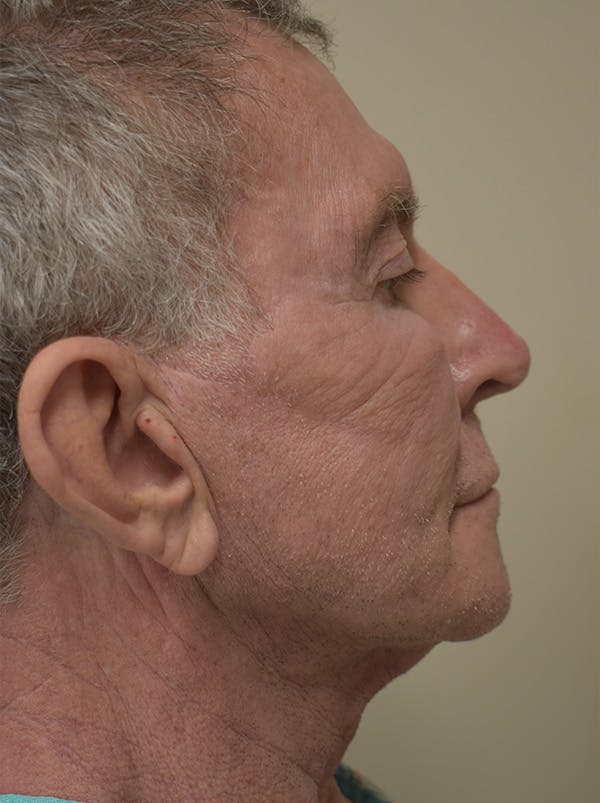 Facelift Before & After Gallery - Patient 166903 - Image 3