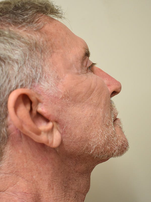 Facelift Before & After Gallery - Patient 166903 - Image 4