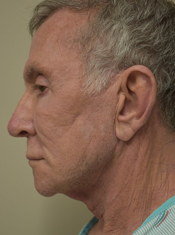 Facelift Before & After Gallery - Patient 166903 - Image 5
