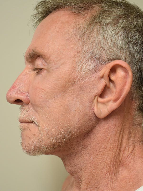 Facelift Before & After Gallery - Patient 166903 - Image 6