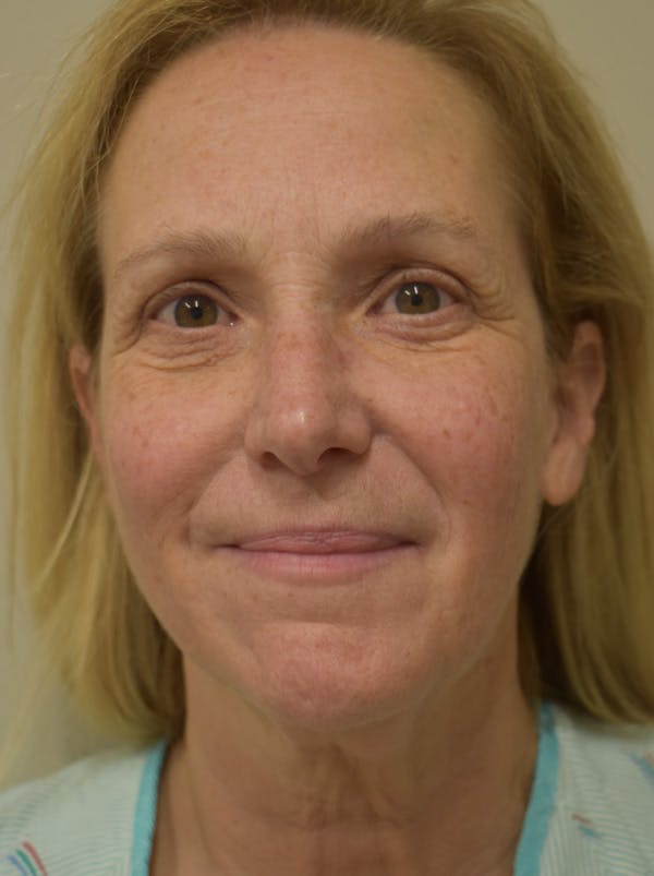 Facelift Before & After Gallery - Patient 335039 - Image 1