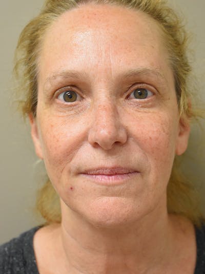 Facelift Before & After Gallery - Patient 335039 - Image 2