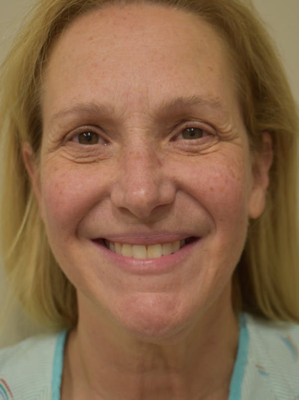 Facelift Before & After Gallery - Patient 335039 - Image 3