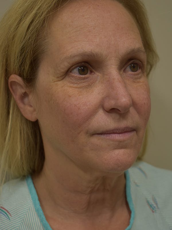Facelift Before & After Gallery - Patient 335039 - Image 5