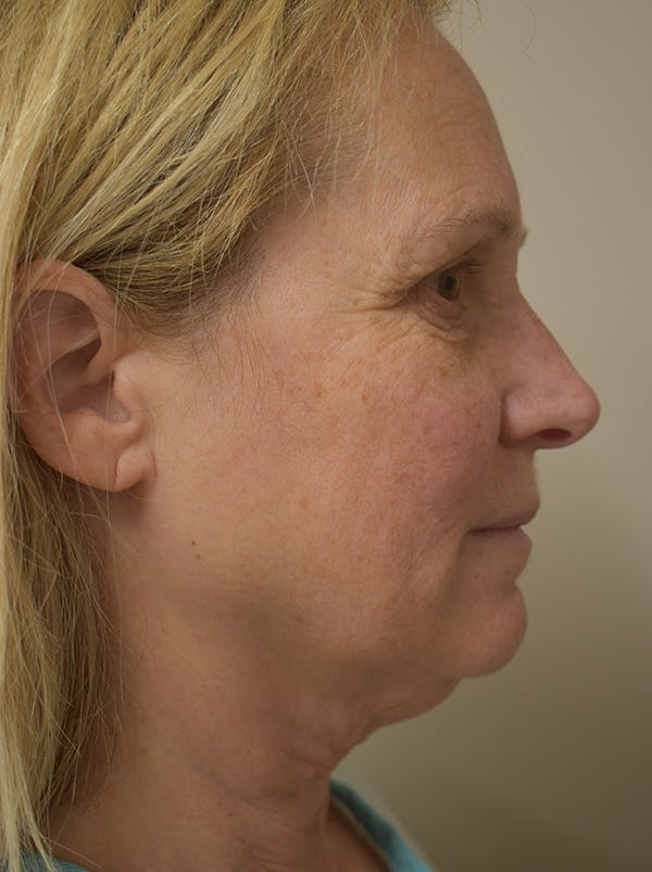 Facelift Before & After Gallery - Patient 335039 - Image 7