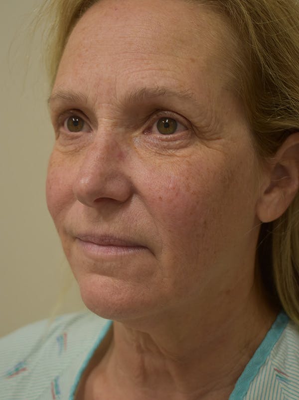 Facelift Before & After Gallery - Patient 335039 - Image 9